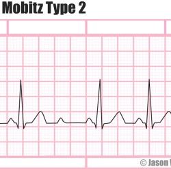 Which type of atrioventricular block best describes this rhythm